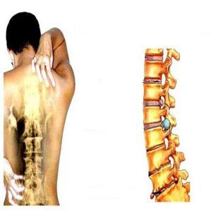 Nivel de osteocondrosis