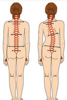 Escoliosis