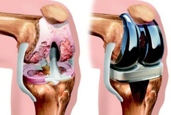 Antes de la rodilla antes y después de endoprotéticos con artrosis